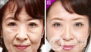 小切口面部提升*果怎么樣？會不會留疤