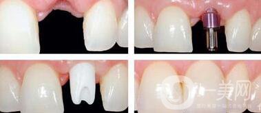 種植牙后要注意什么 種植牙還您一口漂亮的牙齒