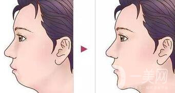 墊下巴用什么材料好？墊下巴改良臉型*果