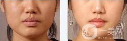 墊下巴用什么材料好？墊下巴改良臉型*果