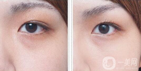 玻尿酸去黑眼圈,術(shù)前準(zhǔn)備