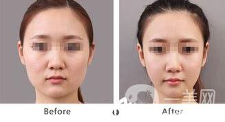 北京哪里吸脂好？吸脂手術(shù)會(huì)反彈嗎