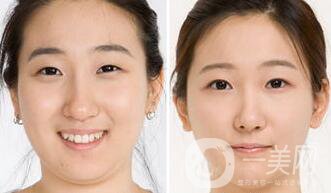 北京哪里吸脂好？吸脂手術(shù)會(huì)反彈嗎