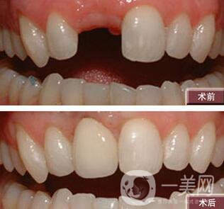 種植牙有什么優(yōu)點(diǎn)？北京種植牙介紹?