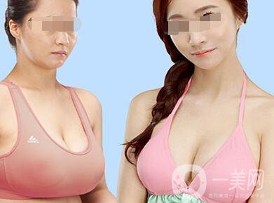 巨乳縮小術(shù)要多久可以恢復(fù)