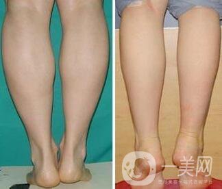射頻瘦小腿保持多久?纖細(xì)雙腿不是夢美