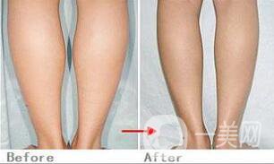 瘦小腿手術(shù)是怎么樣的，具體方法有哪些