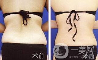 后背吸脂后多久消腫？吸脂術(shù)后如何護(hù)理