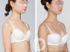 隆胸恢復(fù)期多長時間 性感身材輕松擁有