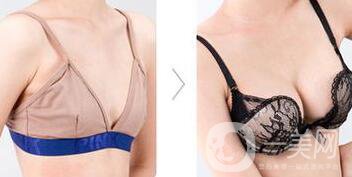 脂肪隆胸失敗如何修復？隆胸修復多少錢