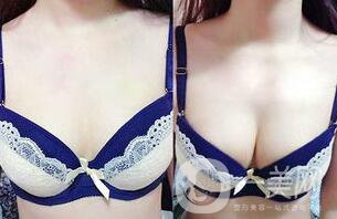 脂肪隆胸失敗如何修復？隆胸修復多少錢