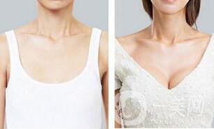 脂肪隆胸失敗如何修復？隆胸修復多少錢