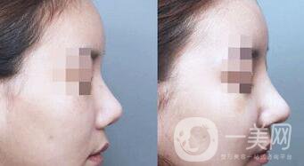 硅膠隆鼻可以管多久 硅膠隆鼻具體費用