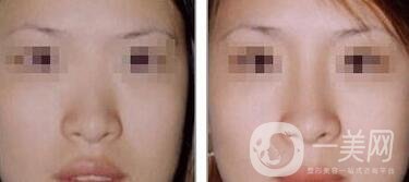 硅膠隆鼻可以管多久 硅膠隆鼻具體費用