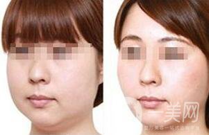 光纖溶脂去雙下巴注意事項詳解