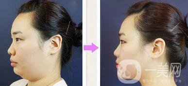 光纖溶脂去雙下巴注意事項詳解