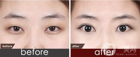 開(kāi)眼角整形手術(shù)之后日常生活要注意什么