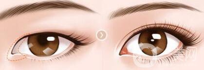 開眼角幾天恢復(fù)？開眼角手術(shù)費(fèi)用介紹