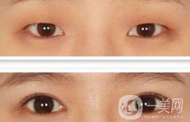 開眼角幾天恢復(fù)？開眼角手術(shù)費(fèi)用介紹