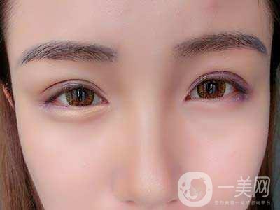 全切雙眼皮恢復(fù)過(guò)程一般是怎樣的 要注意些什么