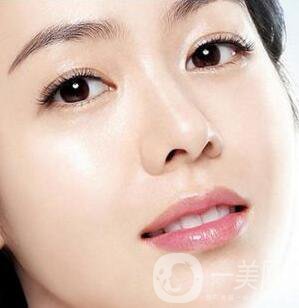 開內(nèi)眼角多久恢復(fù)自然？