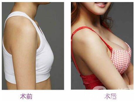 隆胸恢復(fù)期多久正常 隆胸恢復(fù)時(shí)間要多久 2