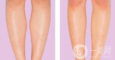 吸脂瘦小腿的危害具體有哪些
