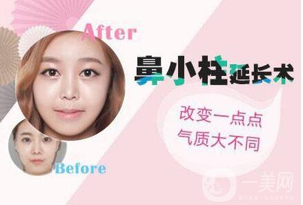 鼻小柱延長,鼻小柱延長費(fèi)用,廣東鼻小柱延長費(fèi)用