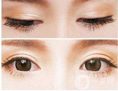 開(kāi)眼角,開(kāi)眼角增生,眼角增生修復(fù)費(fèi)用