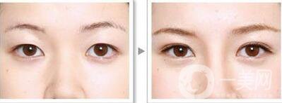 *手術(shù)前準(zhǔn)備有哪些