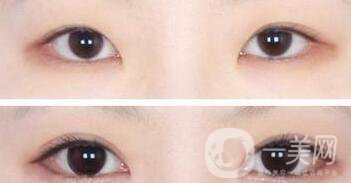 開眼角術(shù)后注意事項(xiàng)具體有哪些