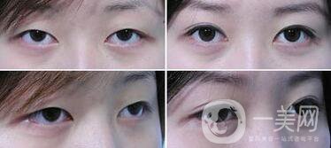 全切雙眼皮增生期是多久