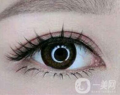 雙眼皮埋線前注意什么？