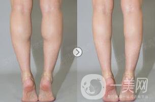 光纖溶脂瘦小腿*果到底怎么樣