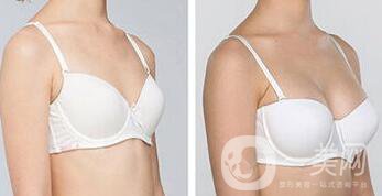 合肥做假體豐胸大概多少錢