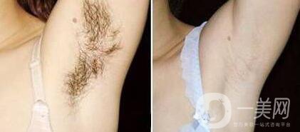 做過(guò)激光脫毛后如何護(hù)理