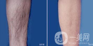 做過(guò)激光脫毛后如何護(hù)理