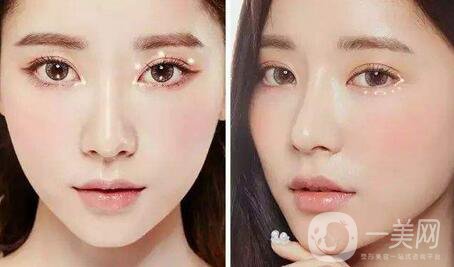 雙眼皮拆線后怎么護(hù)理？