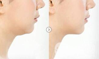 等離子光纖溶脂手術(shù)*嗎