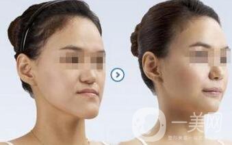 北京頜骨矯正手術(shù)多少錢