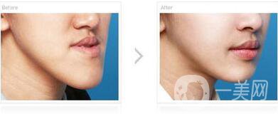 北京頜骨矯正手術(shù)多少錢