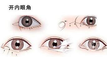 北京做開眼角手術(shù)多少錢