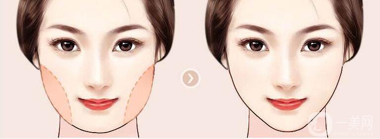 面部吸脂,面部吸脂去雙下巴,面部吸脂去雙下巴*果