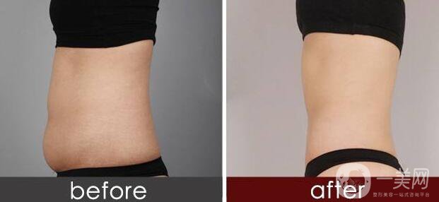 光纖溶脂減肥,光纖溶脂減肥術(shù)后注意事項(xiàng)