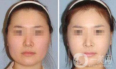 去頰脂墊瘦臉術(shù)后護(hù)理怎么做？