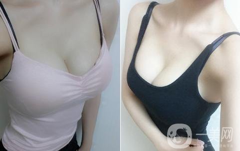 假體隆胸的*果是*性的嗎