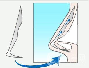 硅膠隆鼻整形之后為什么會(huì)感染