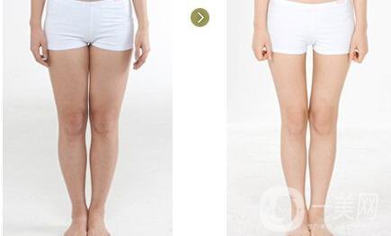 小腿吸脂手術(shù)之后多久會瘦