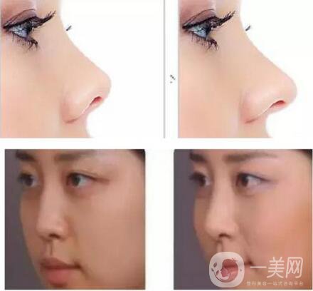 鼻小柱延長恢復過程是怎樣的