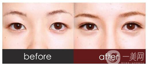 做全切雙眼皮術(shù)前準(zhǔn)備工作有哪些